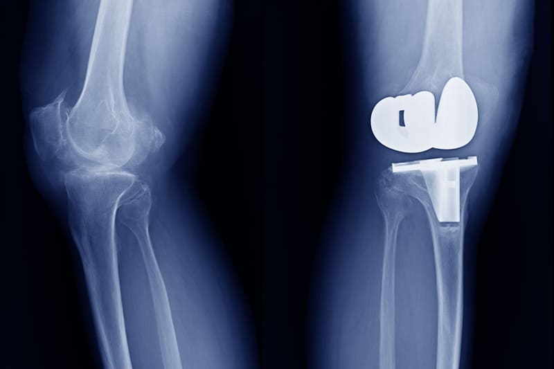 Artroplastia de rodilla